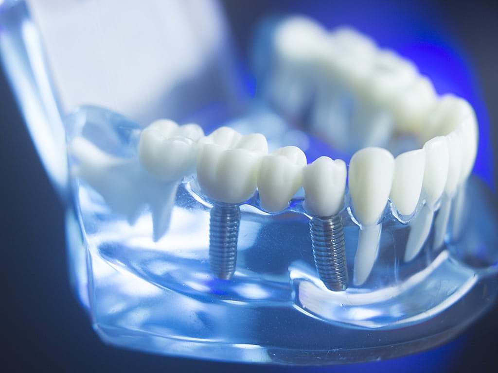Implant dentaire Lyon : pourquoi opter pour cette méthode ?
